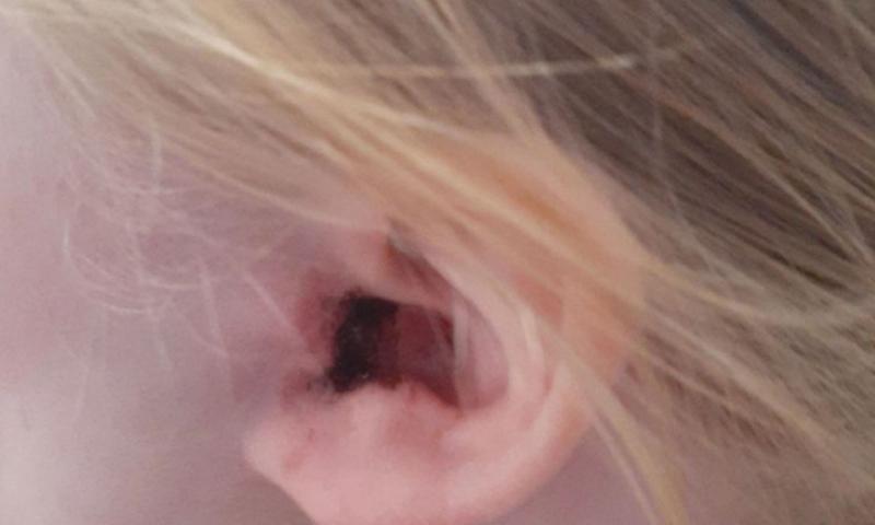 Kleszcz w uchu objawy