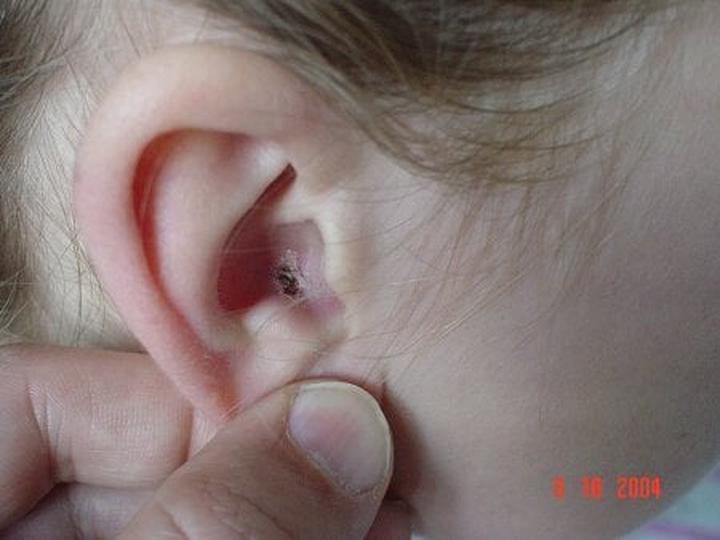 Usuwanie kleszczy z ucha