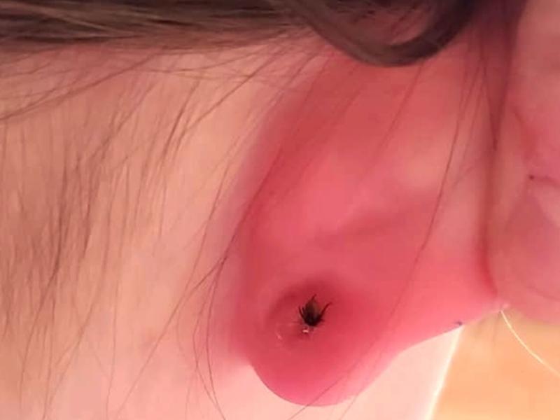 Zapobieganie infestacji kleszczami