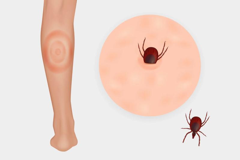 Powikłania po ukąszeniu kleszcza