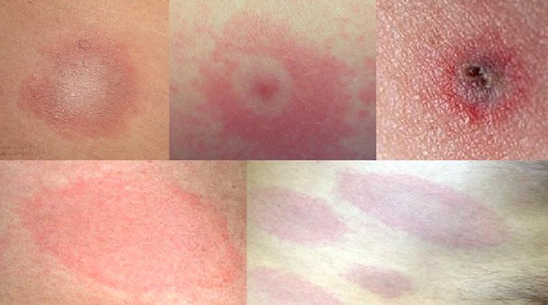 Profilaktyka ukąszeń kleszczy