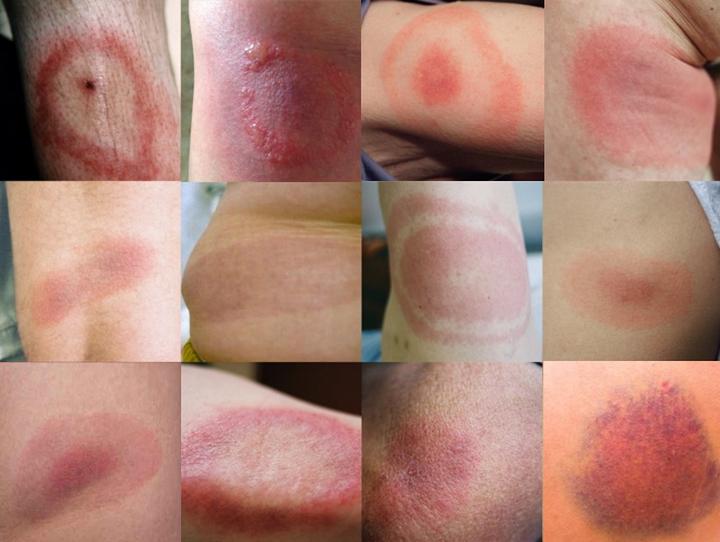 Rumień po kleszczu – rozpoznaj objawy i uniknij powikłań